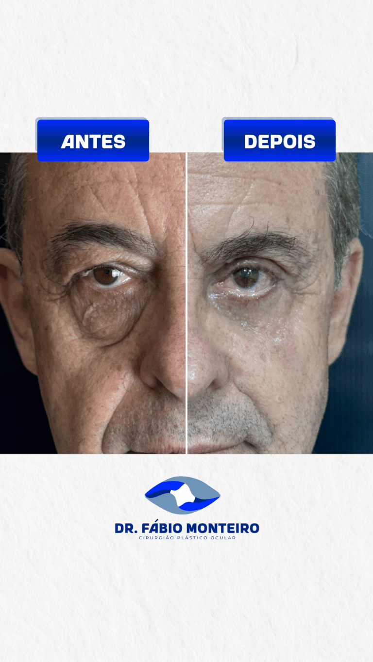 Blefaroplastia