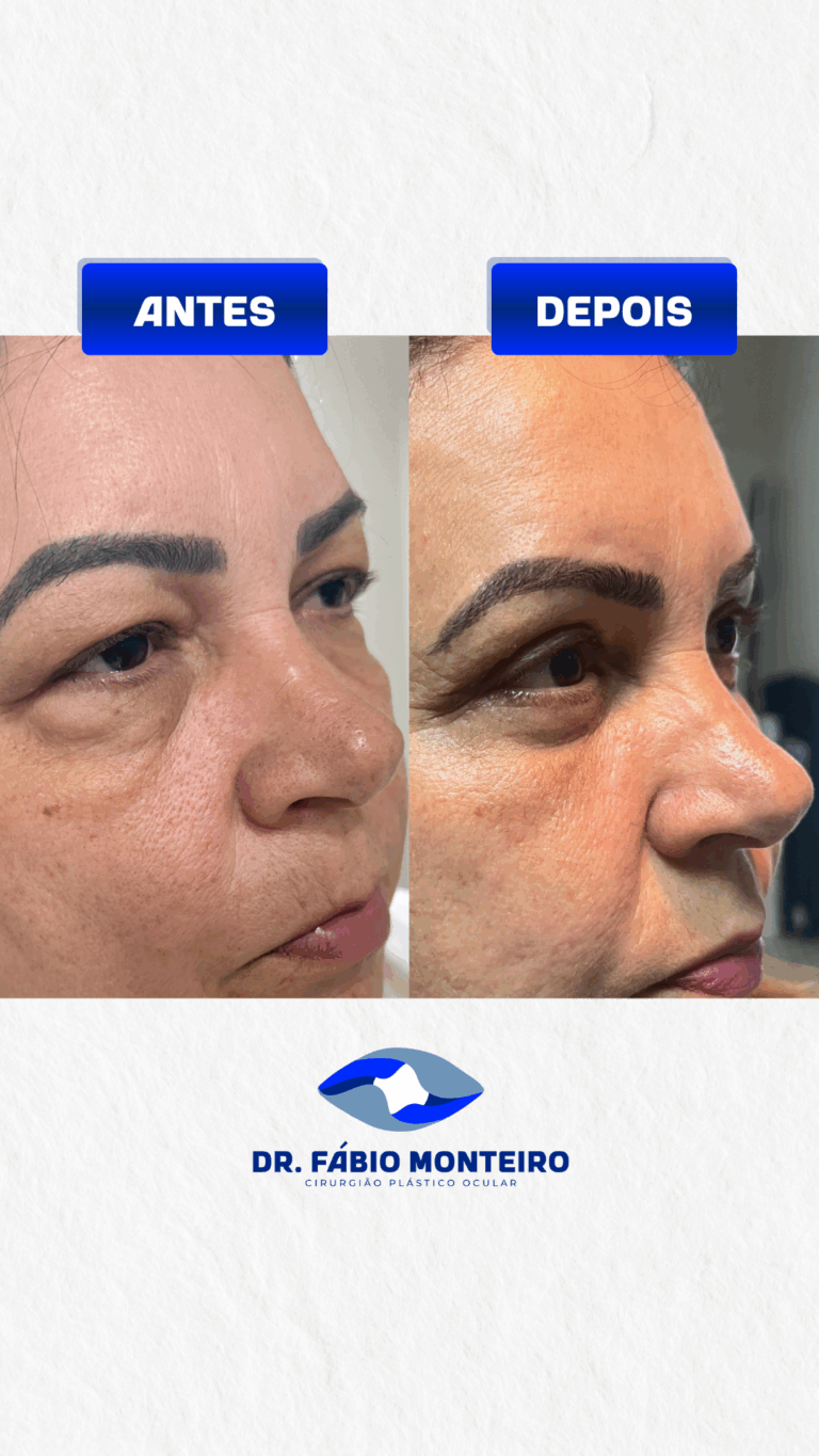 Blefaroplastia
