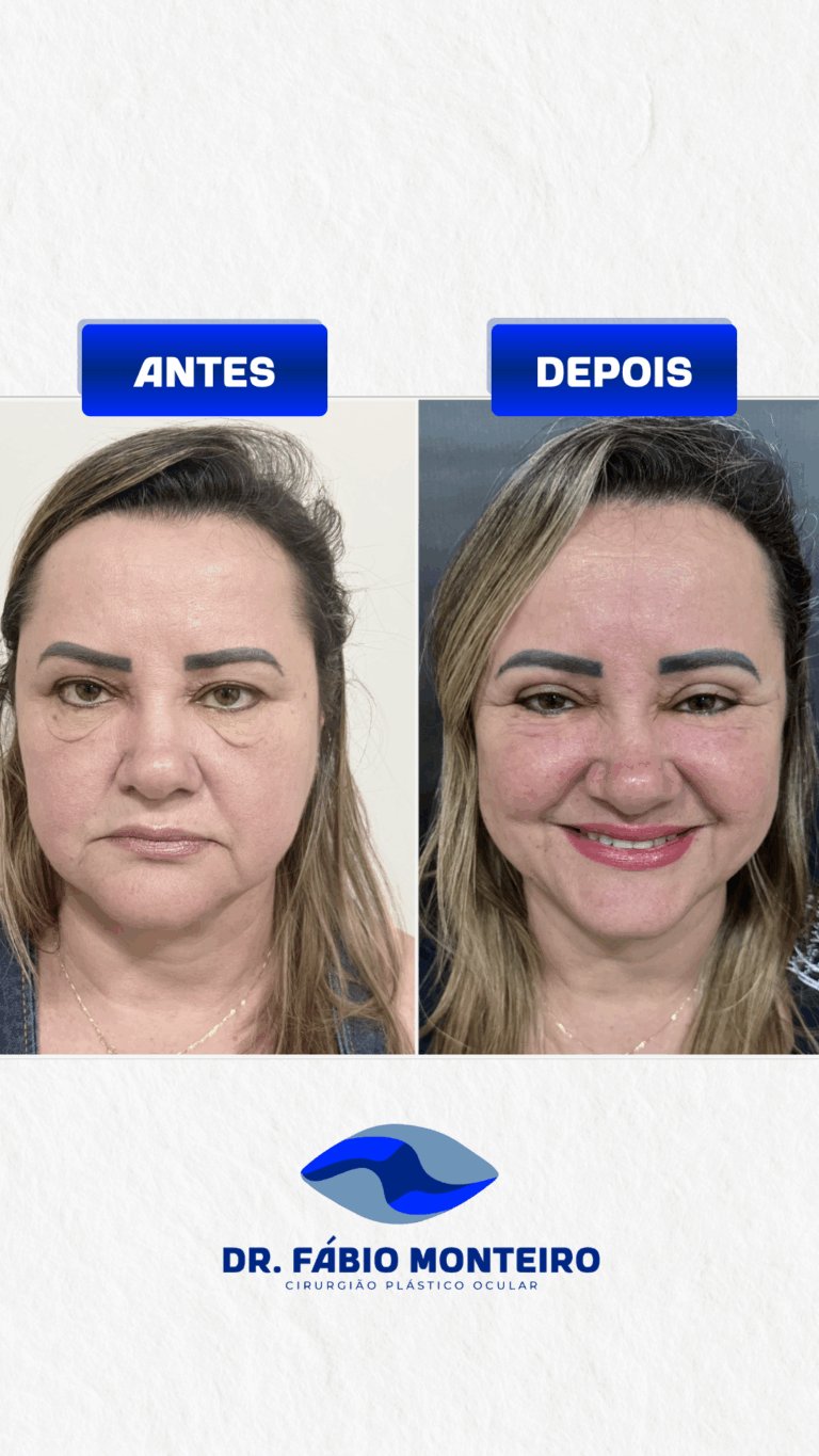 Blefaroplastia