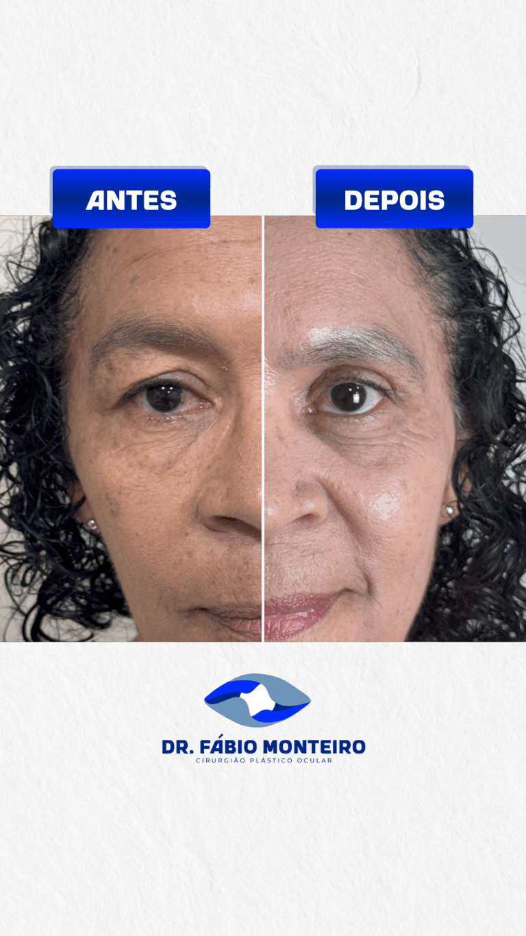 Blefaroplastia
